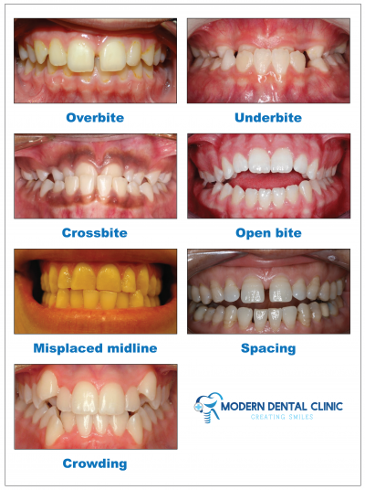 ORTHODONTICS - Modern Dental Clinic, Calicut